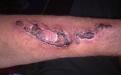 A scab is nature's dressing, none better in these circumstances.
